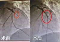 0401【生死時刻，全力以赴】武寧縣人民醫院成（chéng）功搶救一（yī）名急（jí）性（xìng）心肌梗死患者