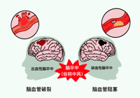 【健康科普】武寧縣人民醫院內二科（kē）：卒中識別早，救治效（xiào）果好（hǎo）！