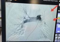 【精湛技術】武寧縣人民醫院胸痛中心團隊成功搶救一名肺栓（shuān）塞患者