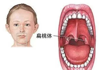 【健（jiàn）康（kāng）科普】兒童扁桃體、腺樣（yàng）體腫大，要手術嗎（ma）？