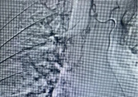 【填補縣域空白】武寧縣總醫院人民醫院院區呼吸內科成（chéng）功（gōng）開（kāi）展首（shǒu）例支氣管動脈造影及栓塞術