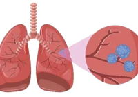 【健康科普】武寧縣總醫院人（rén）民醫院院區外二科：正確認識肺結節，守護您的肺部健康