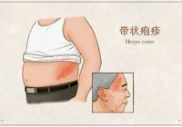 【中秋特輯】武（wǔ）寧縣（xiàn）總醫（yī）院人民醫院院（yuàn）區預防接種門診：接種帶狀皰疹疫苗，守護父母（mǔ）健康